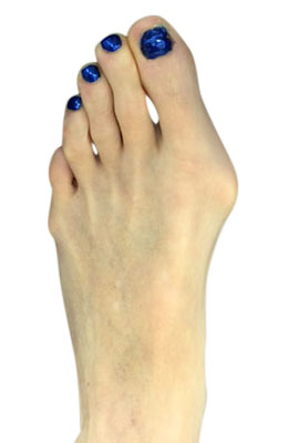 Bunion Correction Surgery - Osteotmoy Bunionectomy - Before Picture