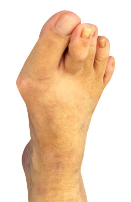 Bunion Correction and Hammertoe Surgery Before Picture, University Foot And Ankle Surgery