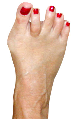 Bunion with Crossover Before Surgery - University Foot and Ankle Institute