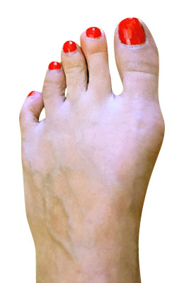 Bunion Correction with Lapidus Procedure Before Picture, University Foot and Ankle Institue