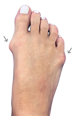 Hammertoe Correction with Bunion Correction Before Surgery Picture