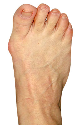 Bunion, Lapidus Bunionectomy Before Surgery - University Foot and Ankle Institute