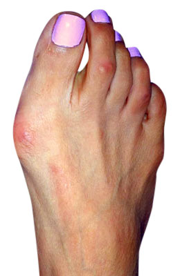 Bunion Before Surgery - University Foot and Ankle Institute