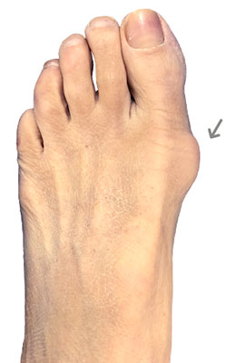 Bunionectomy Before image, University Foot and Ankle Institute