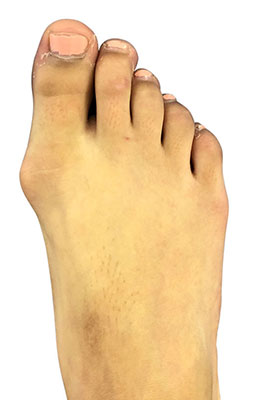 Pediatric bunion surgery, lapidus bunionectomy, before and after picture