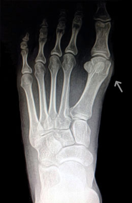 Small Bunion Before Surgery - University Foot and Ankle Institute