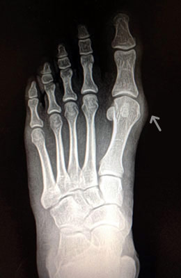 Medium Bunion Before Surgery - University Foot and Ankle Institute