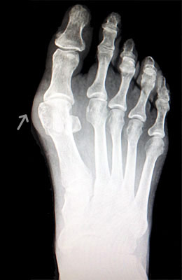 Austin Bunionectomy with Akin Procedure Before Surgery - University Foot and Ankle Institute