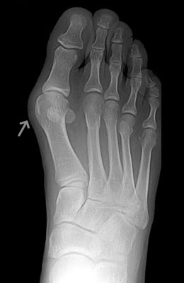 Bunion Before Surgery, Lapidus Bunionectomy - University Foot and Ankle Institute