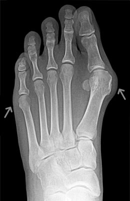 Tightrope Procedure and Osteotomy Tailors Bunion Before Surgery - University Foot and Ankle Institut