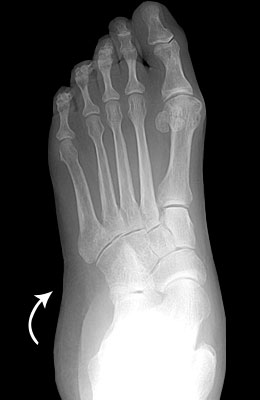 Flat Foot Before Surgery - University Foot and Ankle Institute