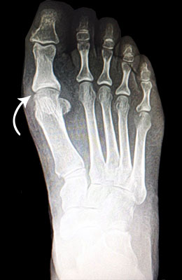 Fusion Before Surgery - University Foot and Ankle Institute
