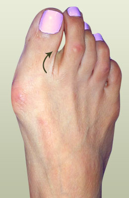 Hammertoe Before Surgery - University Foot and Ankle Institute