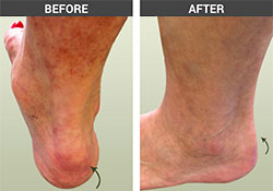 Achilles Spur Before and After - University Foot and Ankle Institute