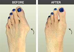 Bunion Surgery Before and After Pictures, Los Angeles