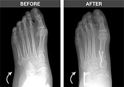 Flat Feet Before and After - University Foot and Ankle Institute