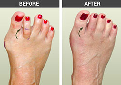 Toe Conditions Before and After - University Foot and Ankle Institute
