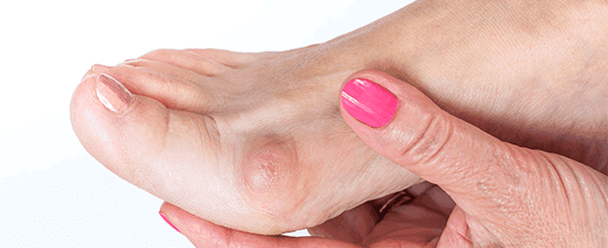 11 Common Foot Lumps and Bumps and What To Do About Them