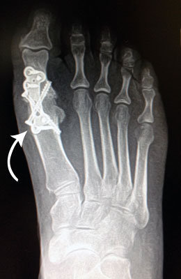 Hallux Limitus Surgery Before Pciture, University Foot and Ankle Institute