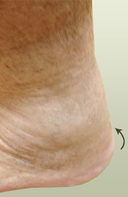Achilles Spur After Surgery - University Foot and Ankle Institute