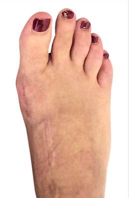 Osteotomy and hammertoe correction after picture, University Foot and Ankle Institute