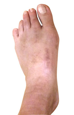 Lapidus, hammertoe and planter plate repair after image