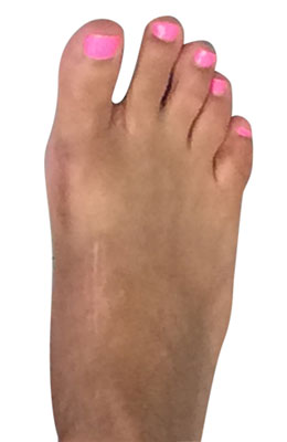 Lapidus Forever Bunionectomy, University Foot and Ankle Institute, After Bunion Surgery Pictures