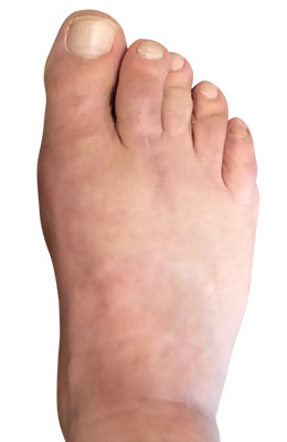 Bunionectomy and Plantar Plate Tear After Image, UFAI
