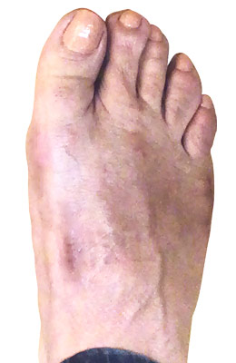 Lapidus Bunionectomy and Neuroma Removal 12 weeks after surgery, UFAI