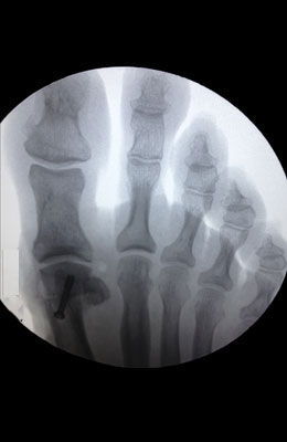 Bunion After Surgery - Osteotomy Bunionectomy - University Foot and Ankle Institute