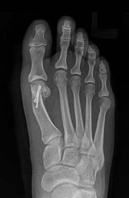 Bunion After Surgery - University Foot and Ankle Institute