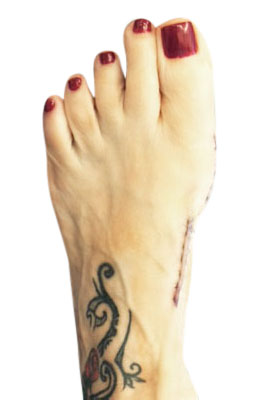 Lapidus Bunionectomy Surgery After Picture, Univeristy Foot and Ankle Institute