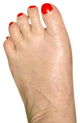 Bunion After Surgery, Lapidus Bunionectomy - University Foot and Ankle Institute