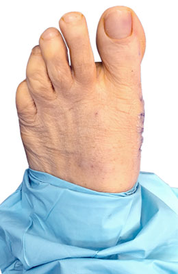Bunionectomy after image, University Foot and Ankle Institute