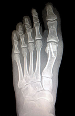 Osteotomy Bunion After Surgery - University Foot and Ankle Institute