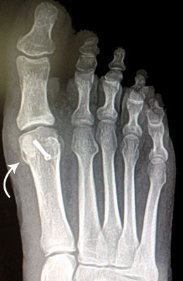 Hallux Limitus Big Toe Arthritis  Post Surgery, University Foot and Anke Insittute