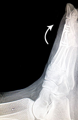 Lateral Fusion After Surgery - University Foot and Ankle Institute