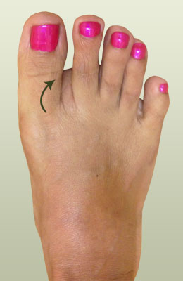 Hammertoe After Surgery - University Foot and Ankle Institute