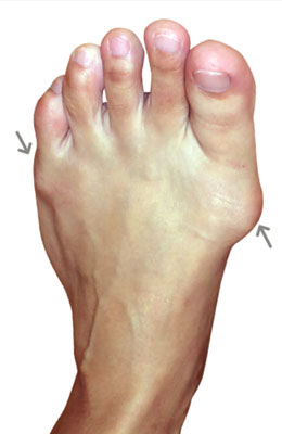 Lapidus Forever Bunionectomy, UFAI, Before and after Bunion Surgery Pictures