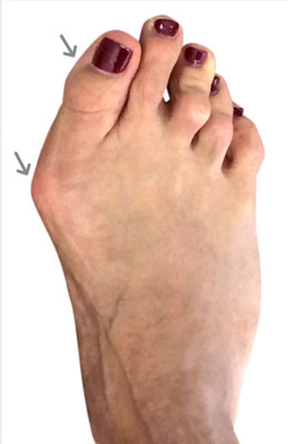 Osteotomy and hammertoe correction before picture, University Foot and Ankle Institute