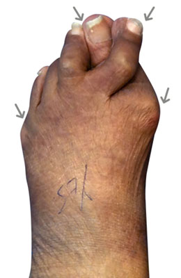 Severe bunion and hammertoe and tailors bunion before image, university foot and ankle institute