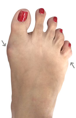 Bunion and Tailors Bunion, Before Image, University Foot and Ankle Institute