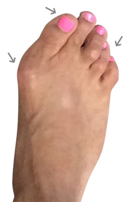 Lapidus Forever Bunionectomy, University Foot and Ankle Institute, Before Bunion Surgery Pictures
