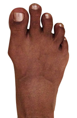 Lapidus Bunionectomy, Hammertoe Correction, Osteotomy Tailors Bunion Surgery Before Picture