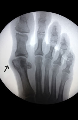 Bunion Before Surgery - Osteotomy Bunionectomy - University Foot and Ankle Institute