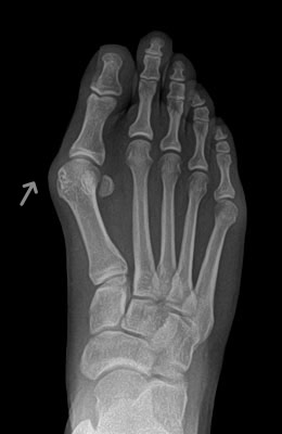Bunion Before Surgery - University Foot and Ankle Institute