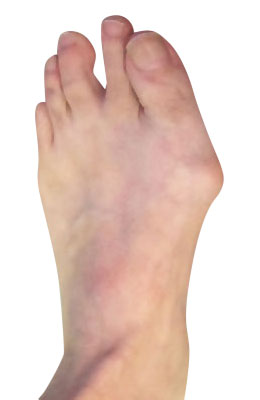 Bunion Surgery Before Picture, University Foot and Ankle Insitute, Lapidus Bunionecotmy Procedure