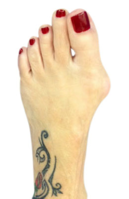 Lapidus Bunionectomy Surgery Before Picture, Univeristy Foot and Ankle Institute