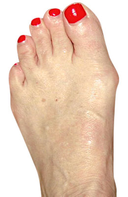 Bunion Before Surgery ,  Lapidus Bunionectomy - University Foot and Ankle Institute
