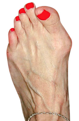 Bunion Osteotomy Before Surgery - University Foot and Ankle Institute